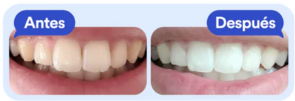 KIT BLANQUEADOR DENTAL