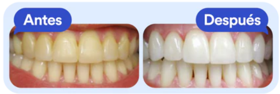 KIT BLANQUEADOR DENTAL