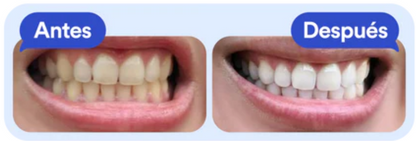 KIT BLANQUEADOR DENTAL